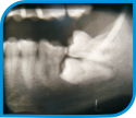 Cirurgia Bucomaxilofacial